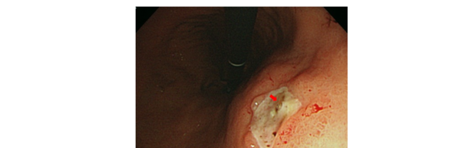 胃潰瘍　止血　内視鏡　画像