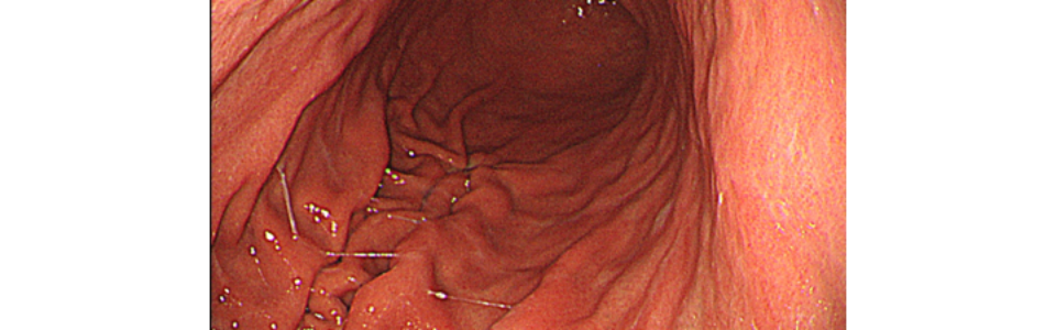 ルーチン上部内視鏡　内視鏡　胃がん