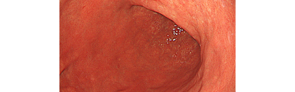 ルーチン上部内視鏡　内視鏡　胃がん