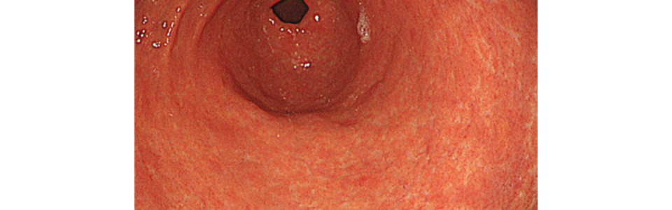 ルーチン上部内視鏡　内視鏡　胃がん