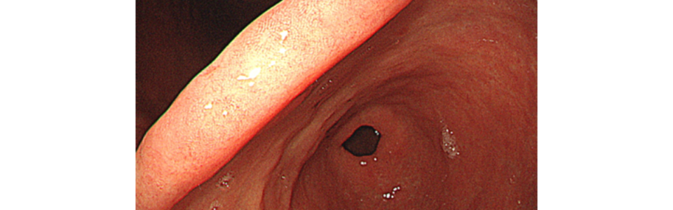 ルーチン上部内視鏡　内視鏡　胃がん